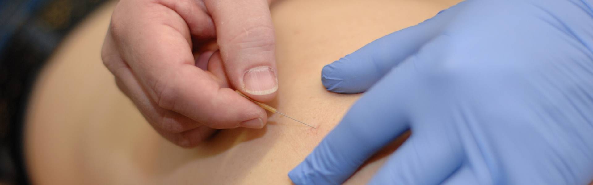 Dry needling- Fysio4 Selwerd - Groningen